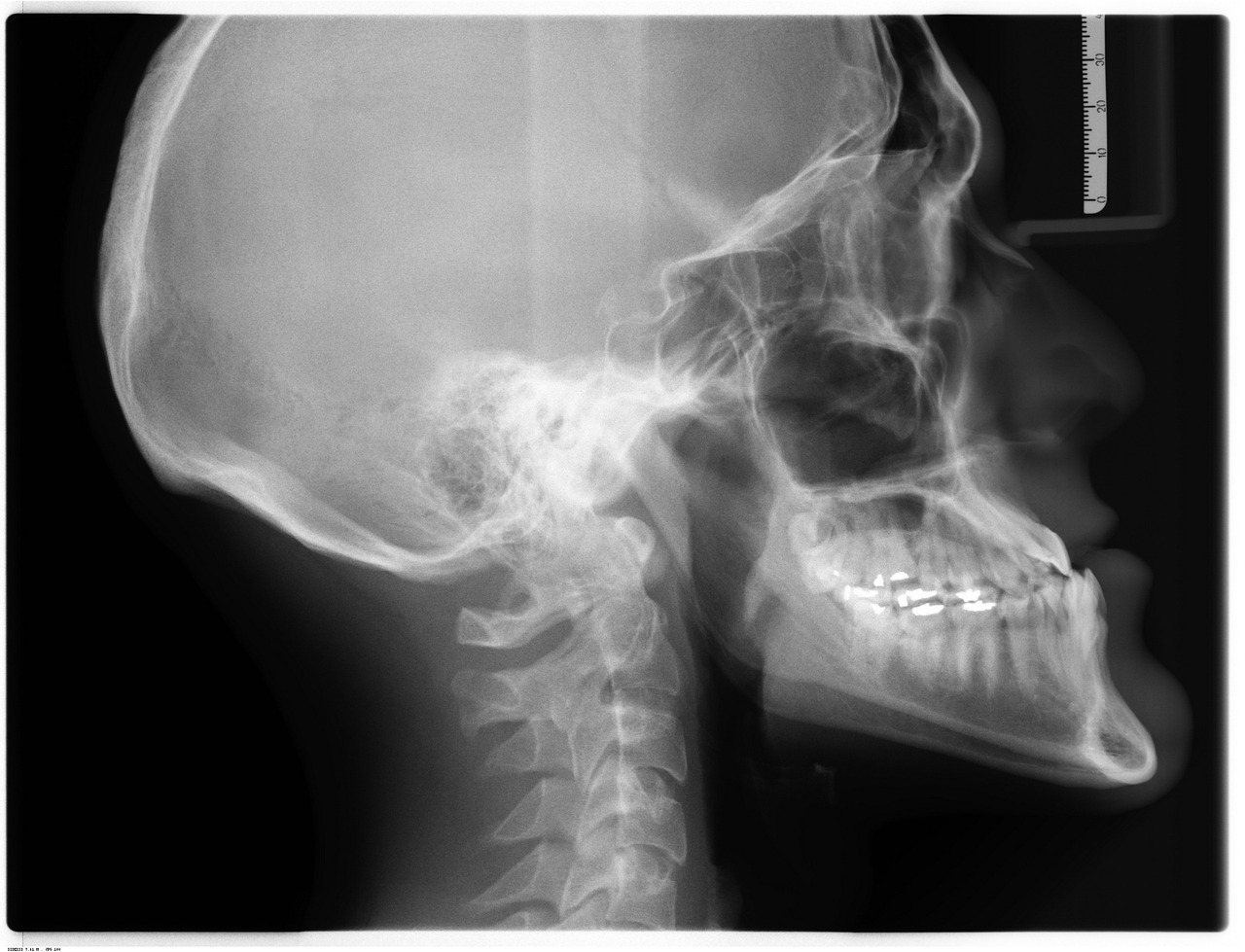 xray, x-ray, radiology, scan, technology, radiological, grayscale, hospital, healthcare, diagnosis, medical, diagnostic, exam, medicine, crooked, teeth, braces, orthodontics, dentistry, yellow, tooth, underbite, jaw surgery, side, skeleton, gray hospital, gray medical, gray medicine, gray teeth, gray healthcare, xray, xray, xray, xray, xray, x-ray, radiology